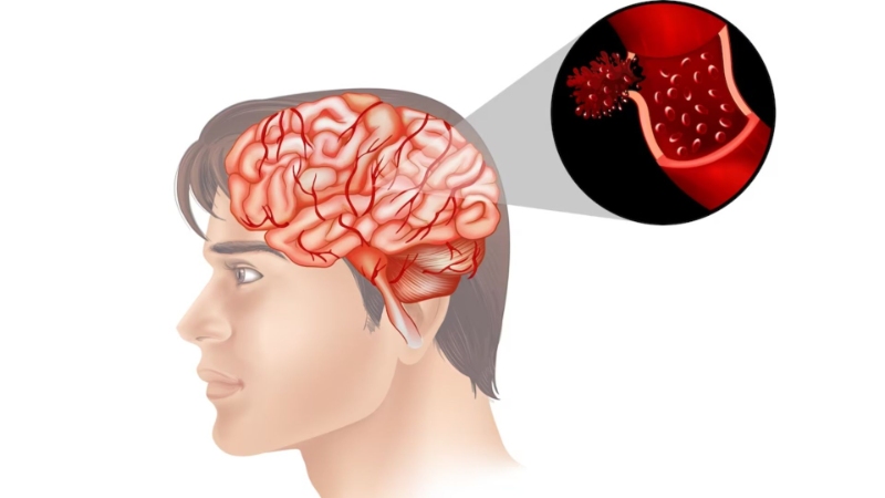 Causes of Hemorrhagic Stroke