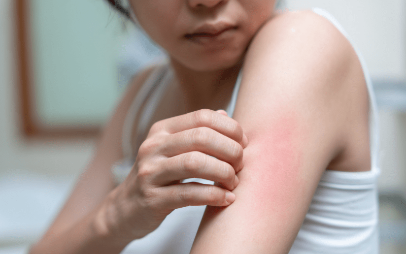 What is Dengue Fever Recovery Phase | Dengue Recovery Symptoms, Home Remedies