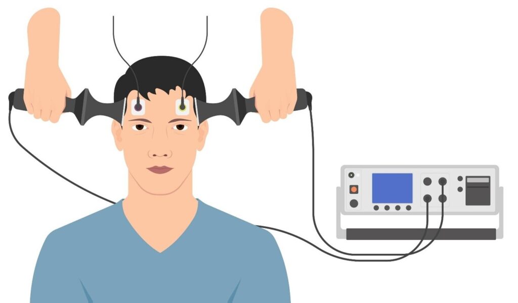 What is Electroconvulsive Therapy? Definition, Side Effects