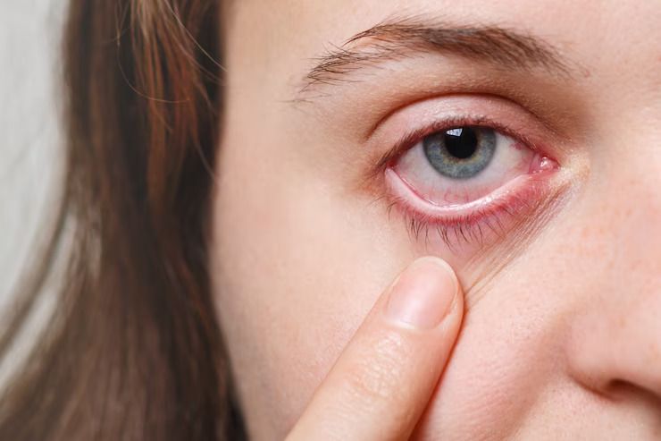 Eye Flu Medicine