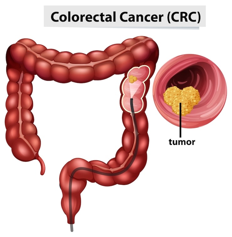 Gallbladder Cancer