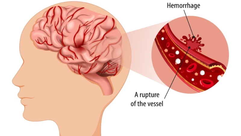 What is Hemorrhagic Stroke Paralysis