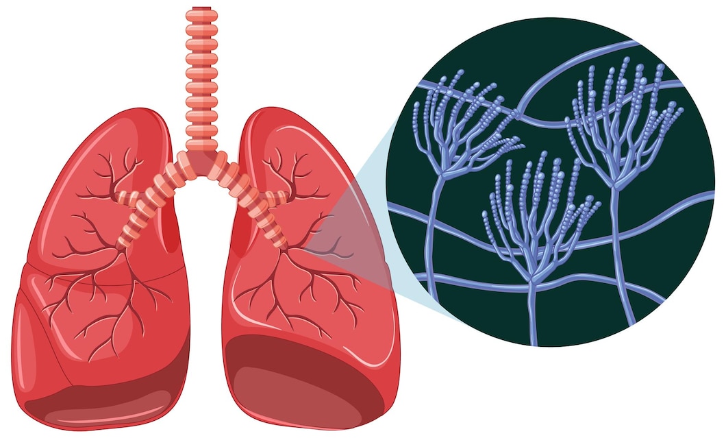How Serious is Latent Tuberculosis? -Symptoms, Risk Factors