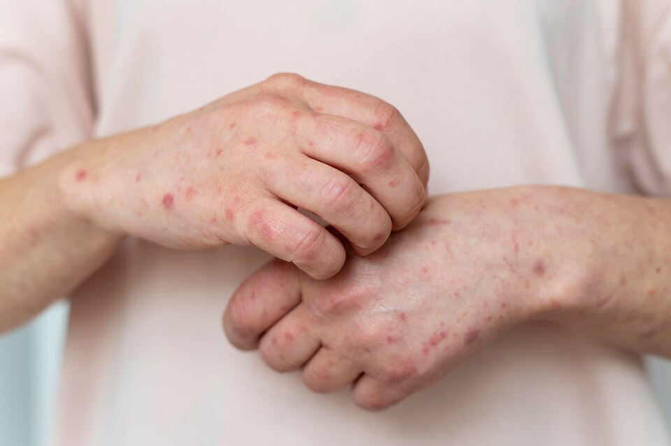 Roseola image