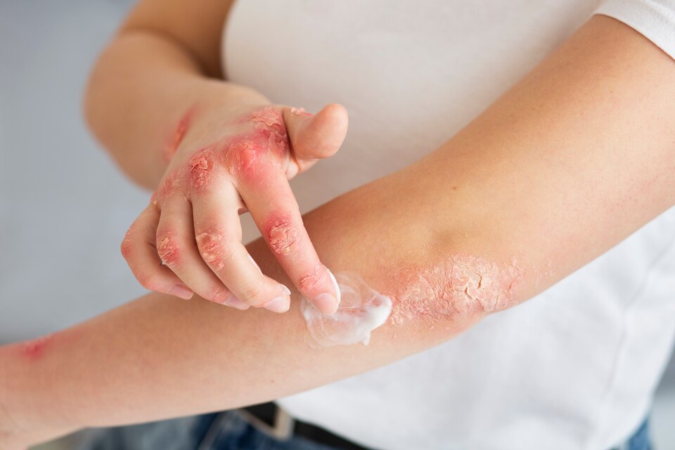 Roseola treatment
