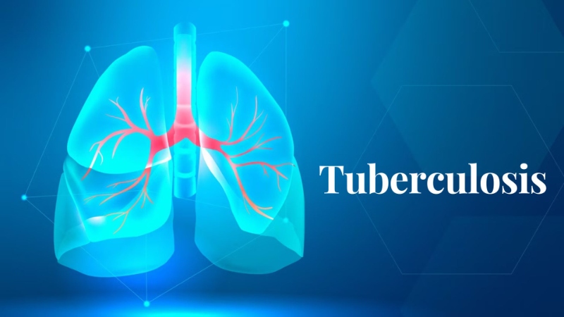 Tuberculosis