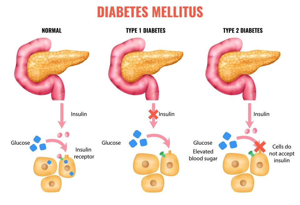 types of diabetes