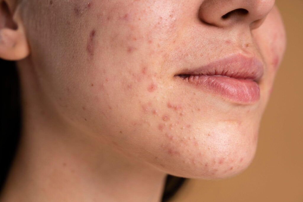 Acne Treatment in Hindi