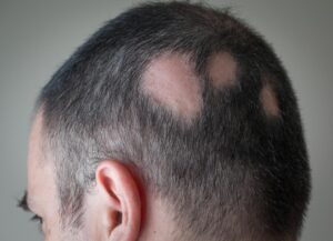 Alopecia Areata Treatment in Hindi