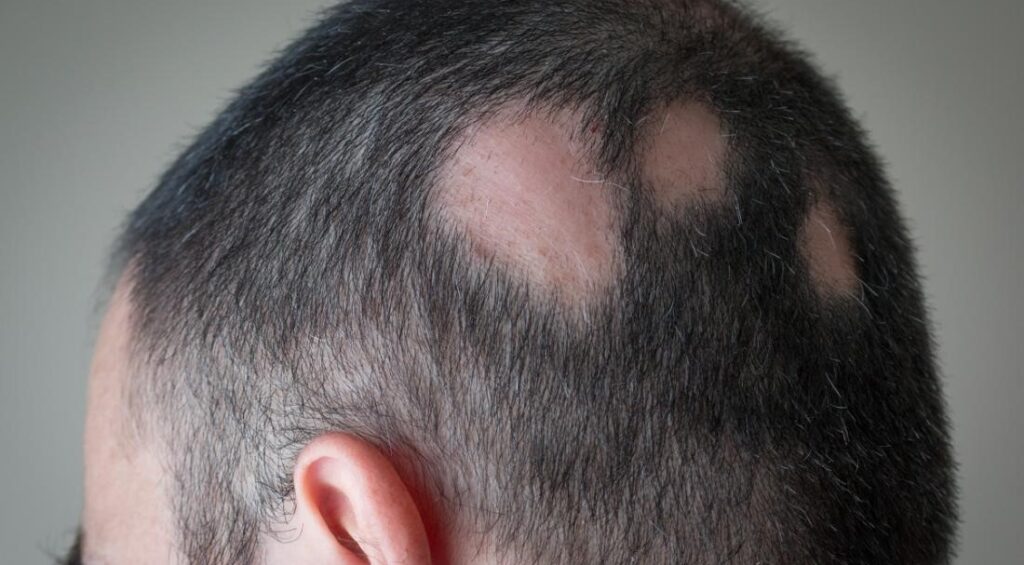 Conditions of Alopecia Areata image