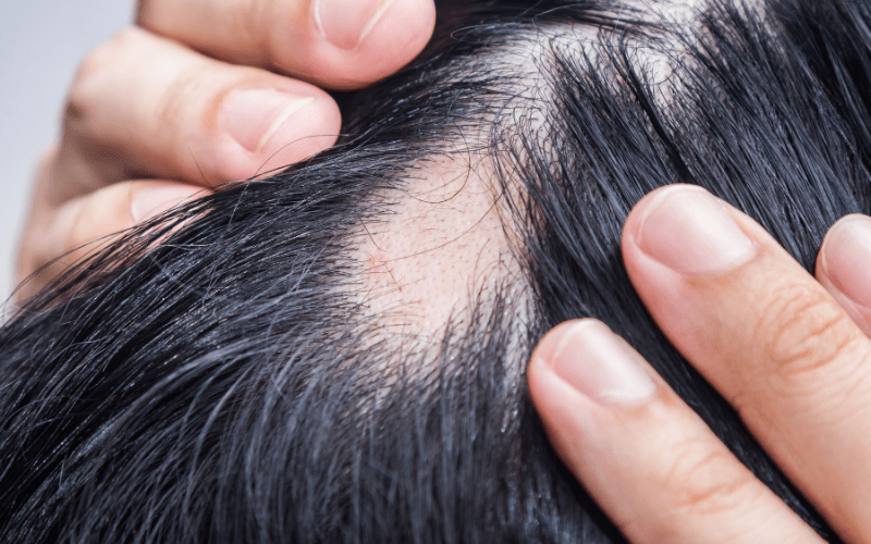 Alopecia Areata Treatment | Ayurvedic Medicine for Alopecia Areata