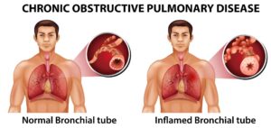 Bronchitis Treatment in Hindi