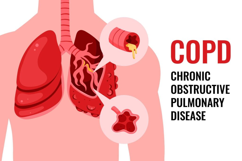 Best Treatment for COPD: Patients, Medication, COPD Treatment