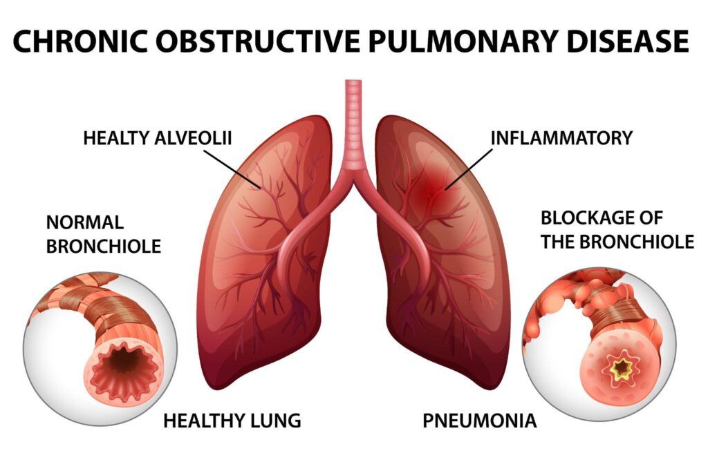 Best Treatment for COPD: Patients, Medication, COPD Treatment