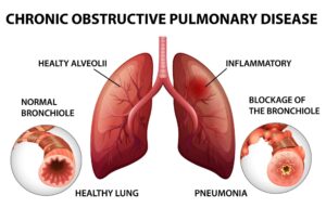 COPD Treatment in Hindi