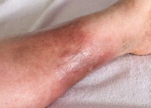 Cellulitis Treatment in HIndi