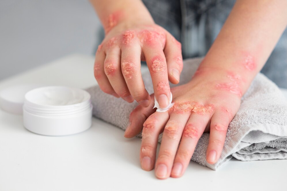 Fungal Infection Treatment: Home Remedies, Fungal Nail Infection