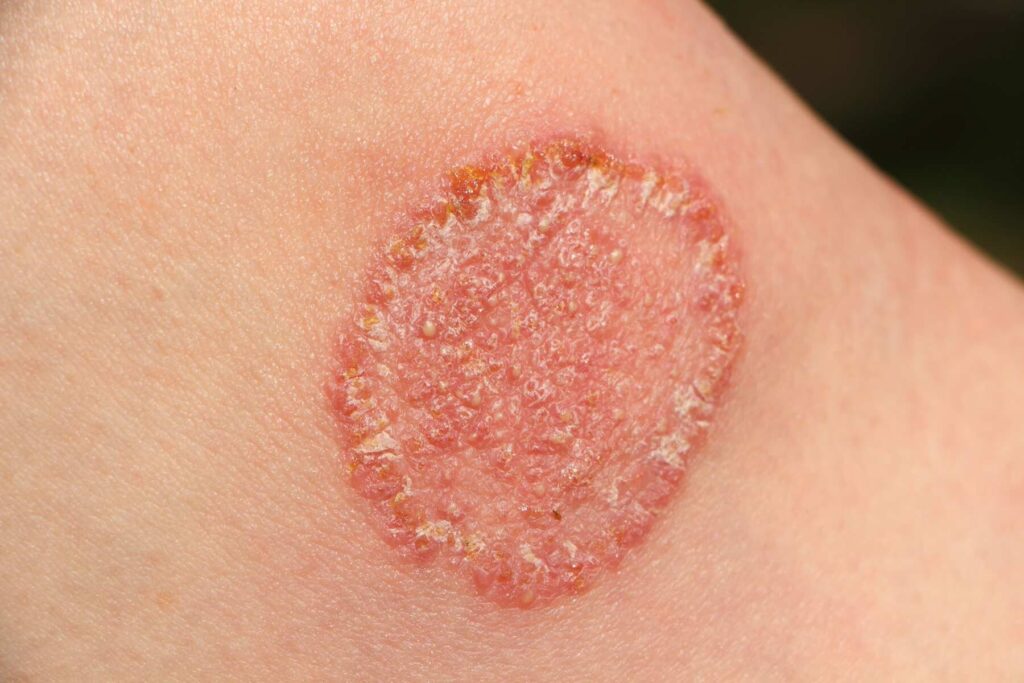 Fungal skin Infection Treatment