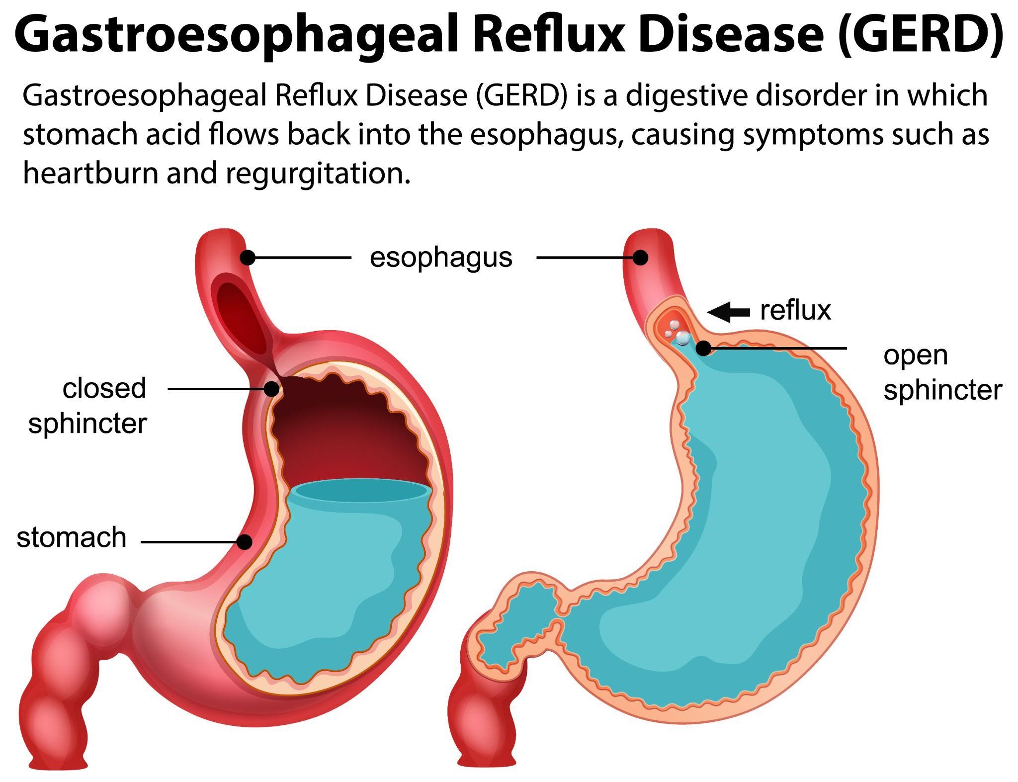 GERD Treatment