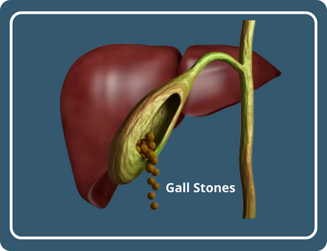 Gallbladder Stones Treatment at Home: Ayurvedic Treatment