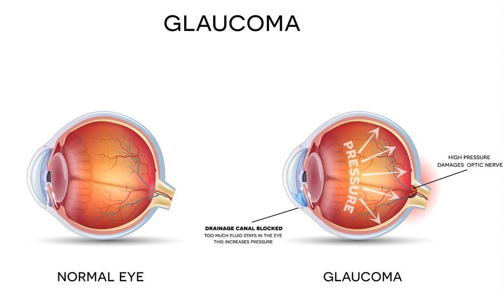 Glaucoma Treatment