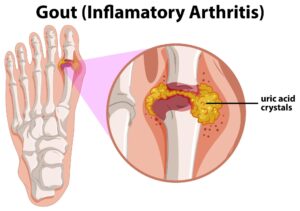 Gout Treatment in Hindi