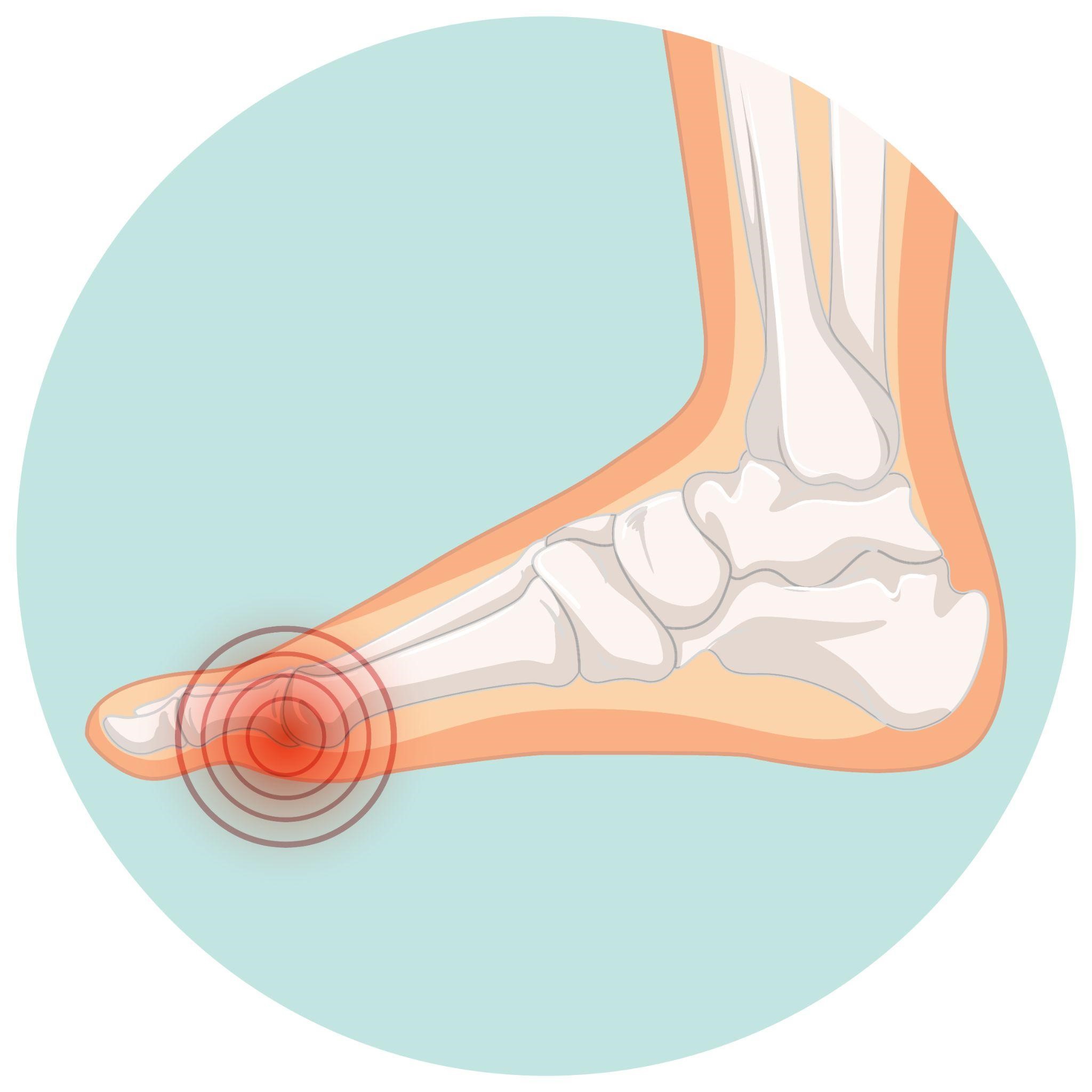 Gout Treatment: Home Remedies, Medication, Treatment of Gout