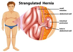 Hernia Treatment