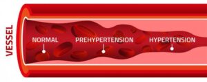 Hypertension Treatment in Hindi
