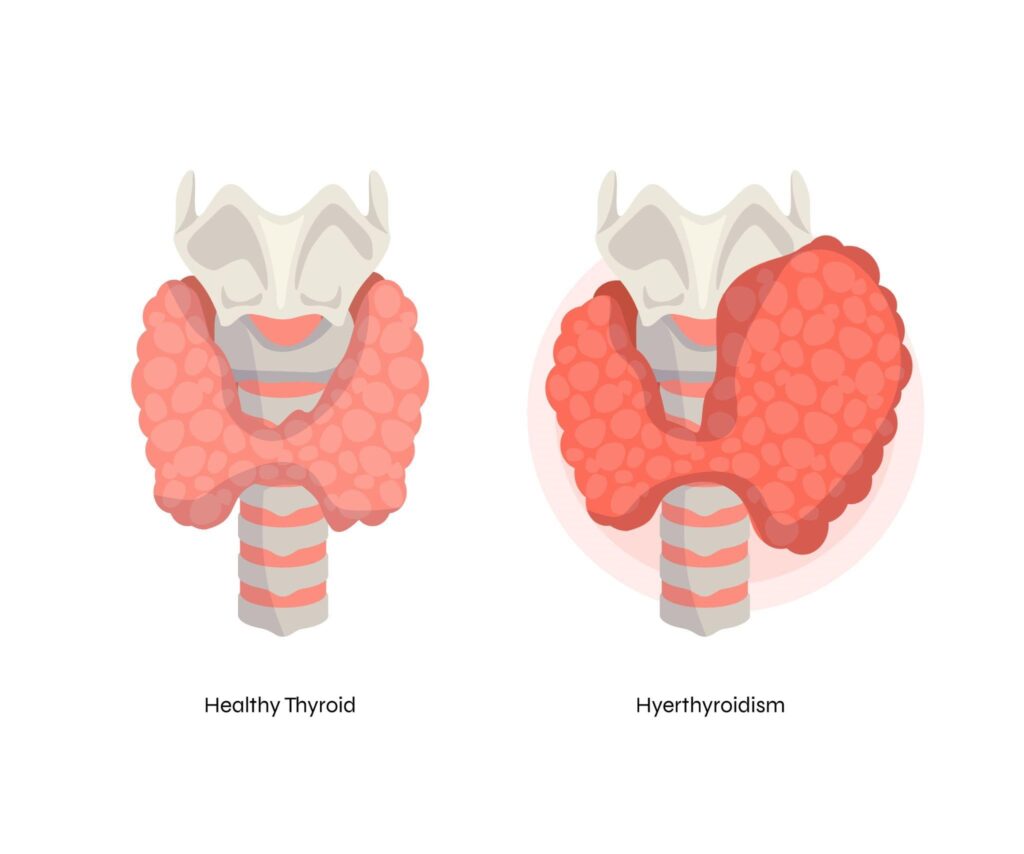 Hyperthyroidism treatment and diagnosis medication symptoms