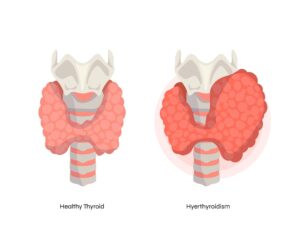 Hyperthyroidism Treatment