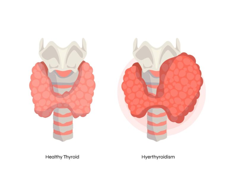 Hyperthyroidism Treatment and Diagnosis: Medication, Symptoms