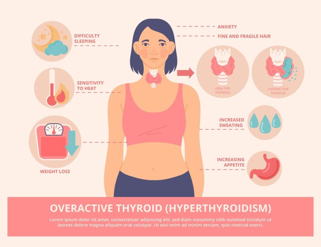 Hyperthyroidism Treatment