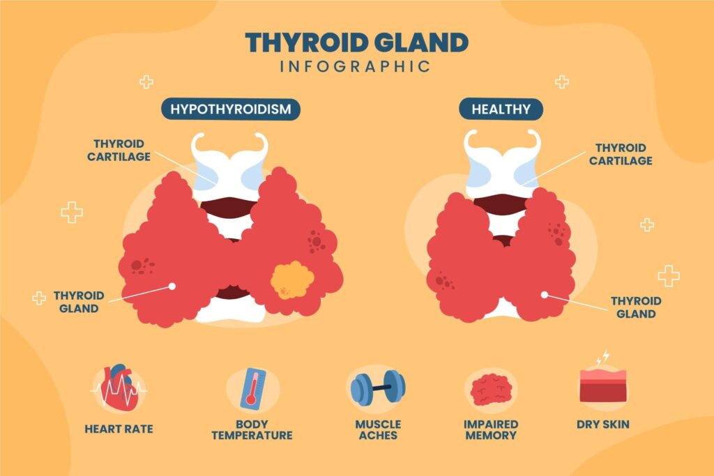 Hypothyroidism Treatment Hypothyroidism Natural Treatment