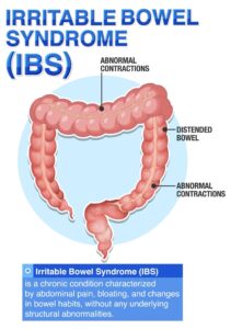 IBS Treatment