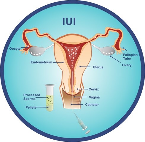 IUI Treatment in Hindi