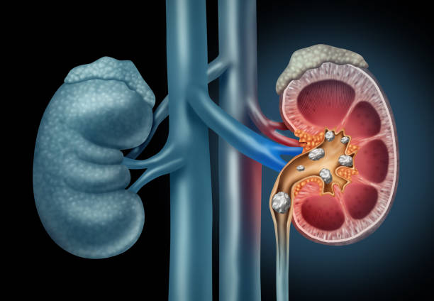 Kidney Stone Treatment in Hindi