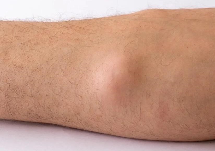 Lipoma Treatment in Hindi