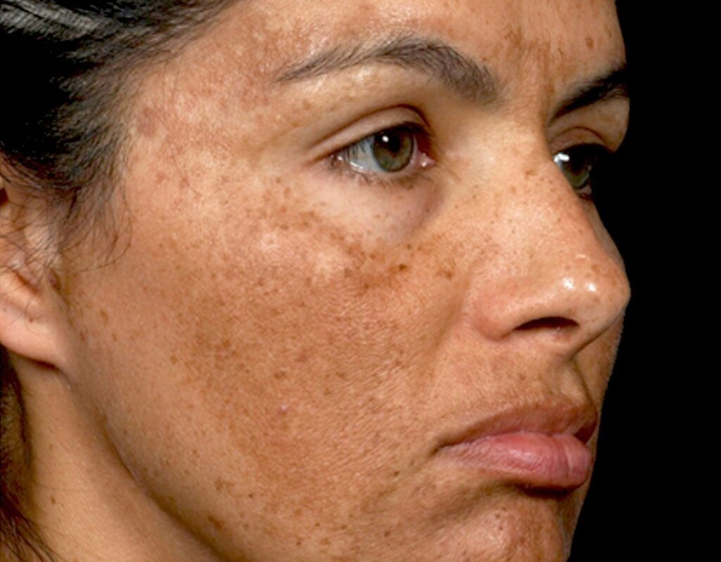 Melasma Treatment in Hindi