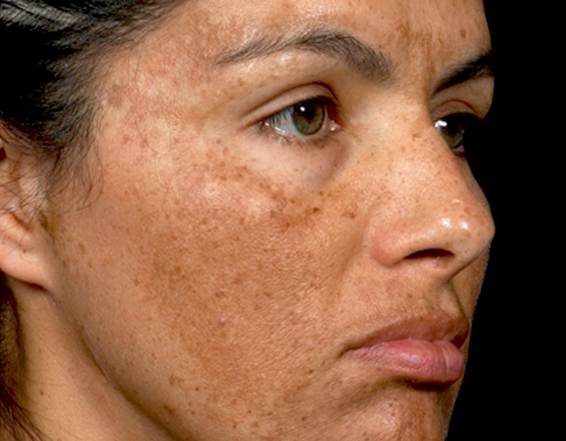 Best Treatment for Melasma on Face: Melasma Home Remedies