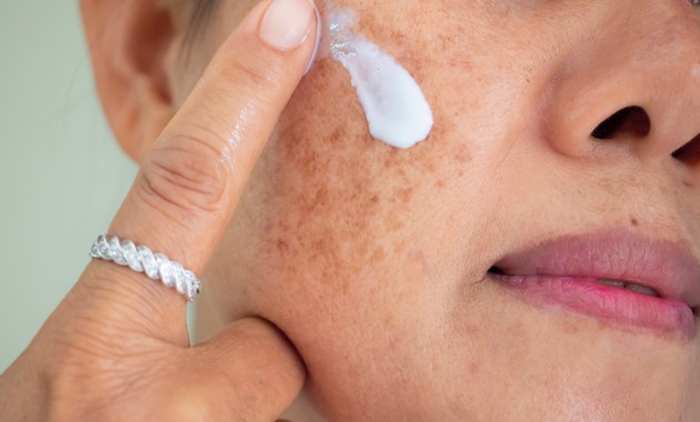 Melasma Treatment