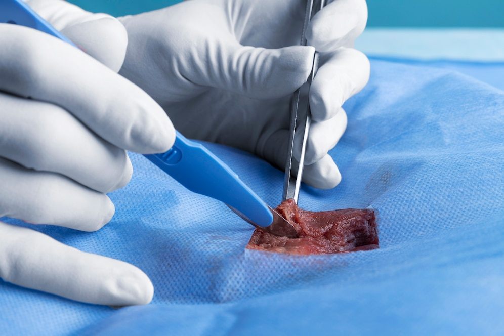 Phimosis Treatment