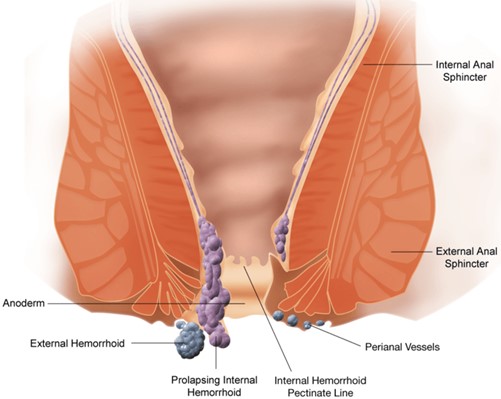 Piles Treatment