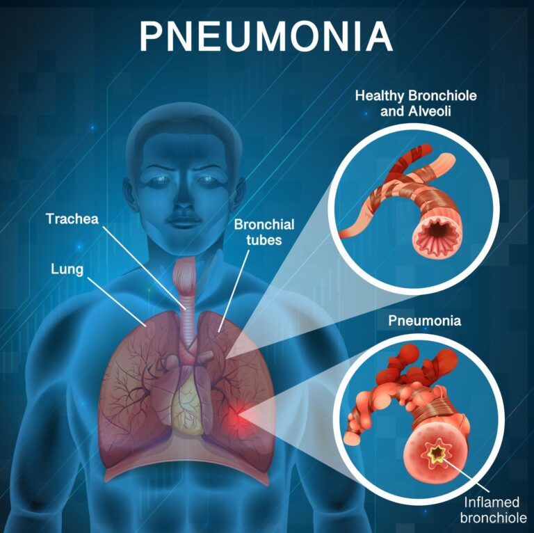 Pneumonia Treatment and Recovery - Best Home Remedies