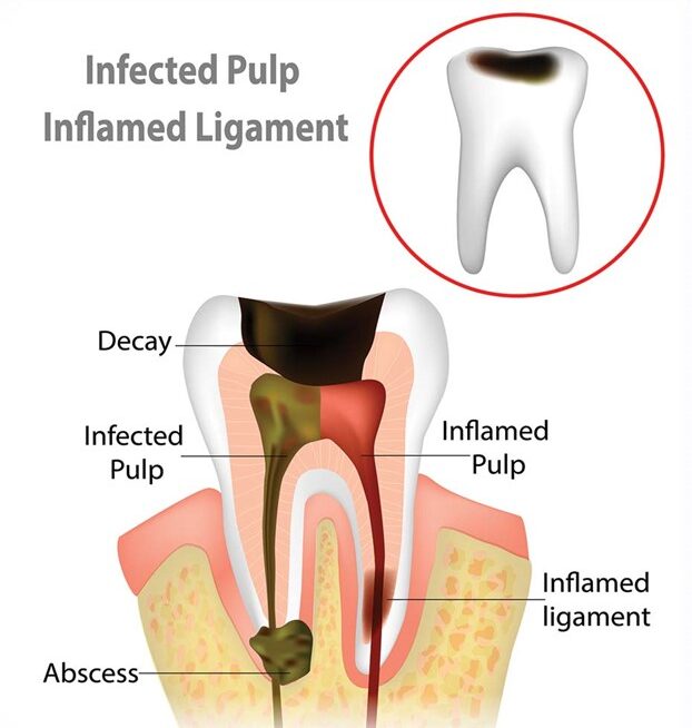 Root Canal image