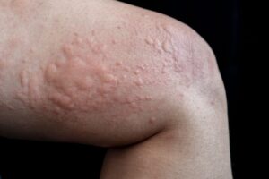 Urticaria Treatment in Hindi