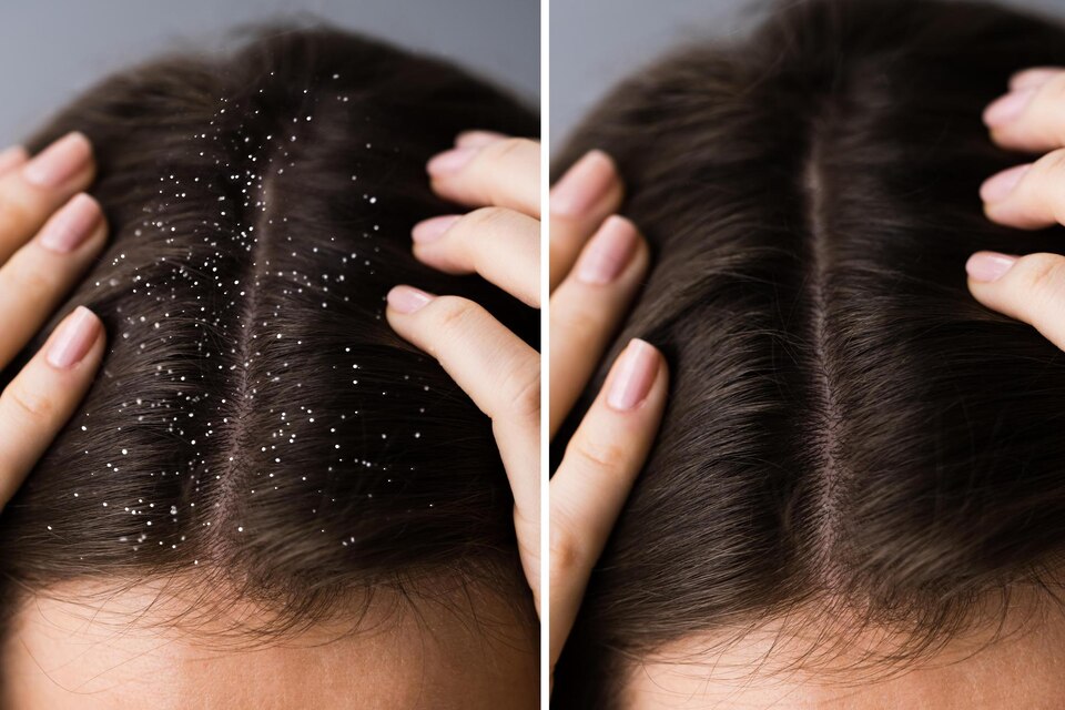 best dandruff treatment