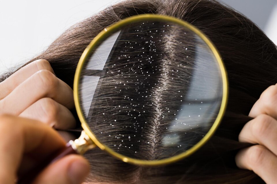 dandruff treatment