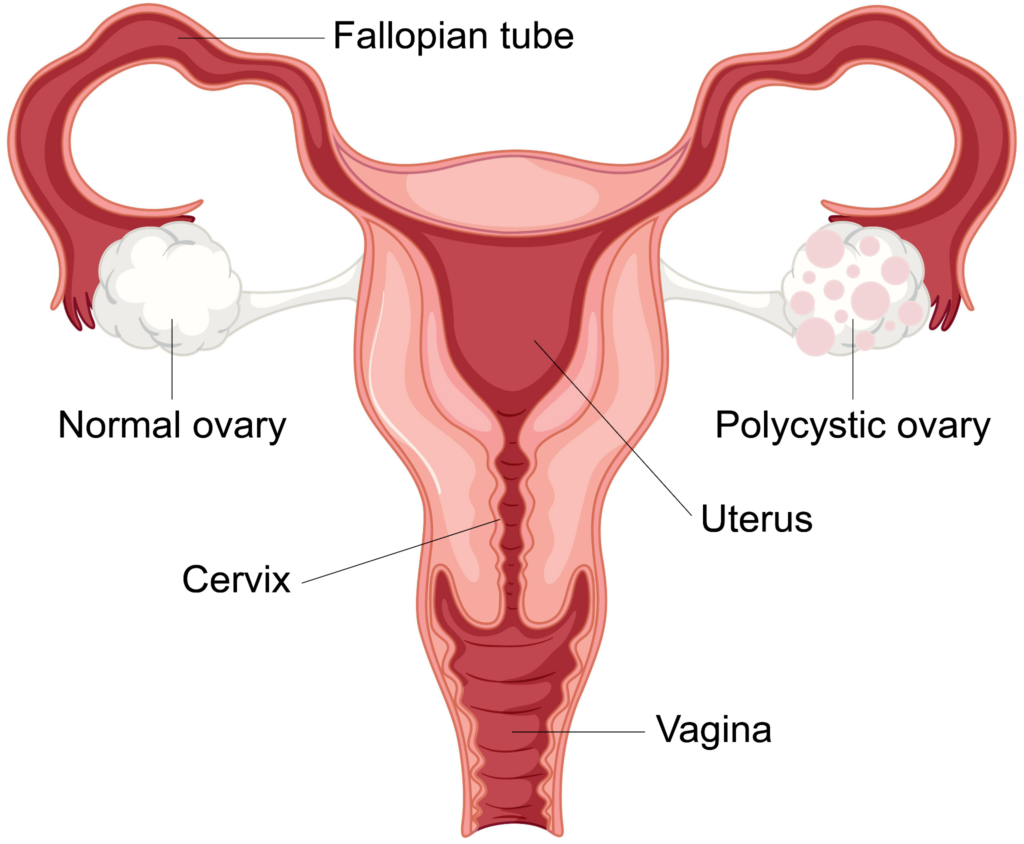 PCOS Treatment in Hindi