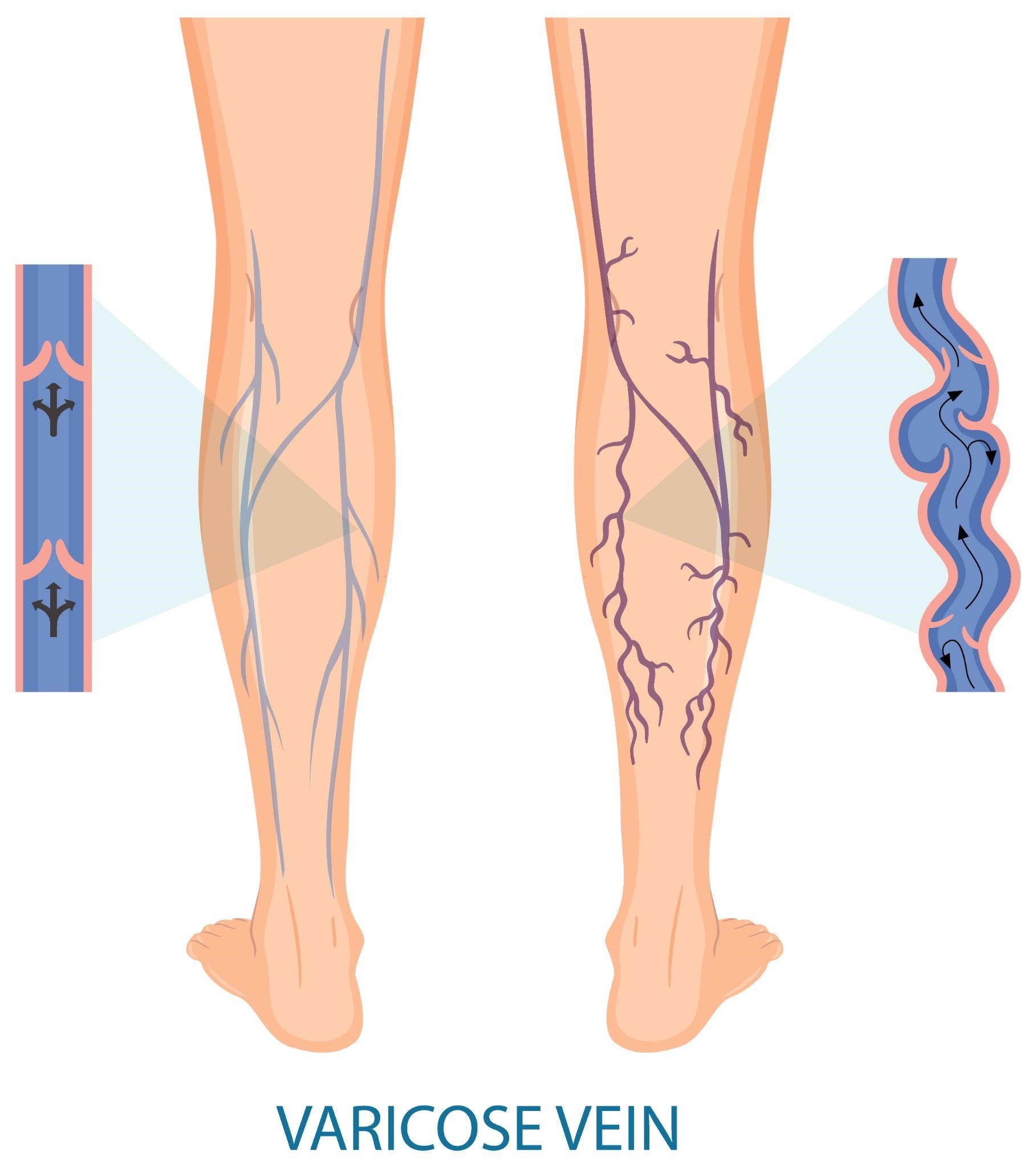 Varicose Veins Treatment in Ayurveda - Laser Treatment